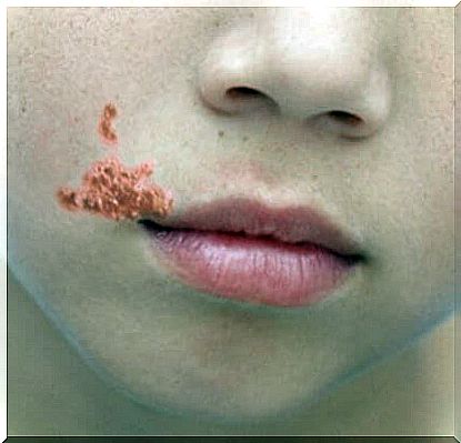 Contagious impetigo in children: causes and treatment