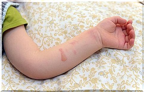 What should I do if my child gets a burn from hot water?